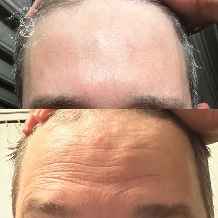 Before and after Botox at Opal Aesthetics Bakersfield