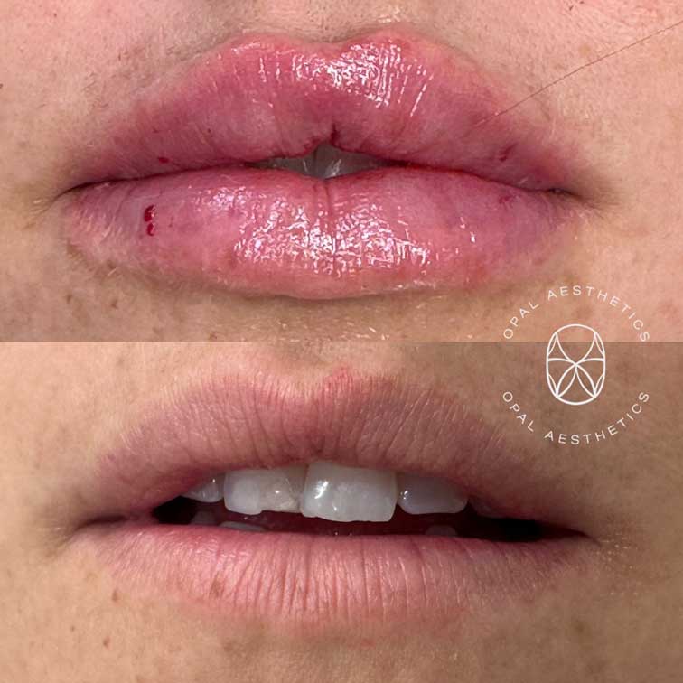 Before and after Lip Enhancement With HA Filler at Opal Aesthetics Bakersfield