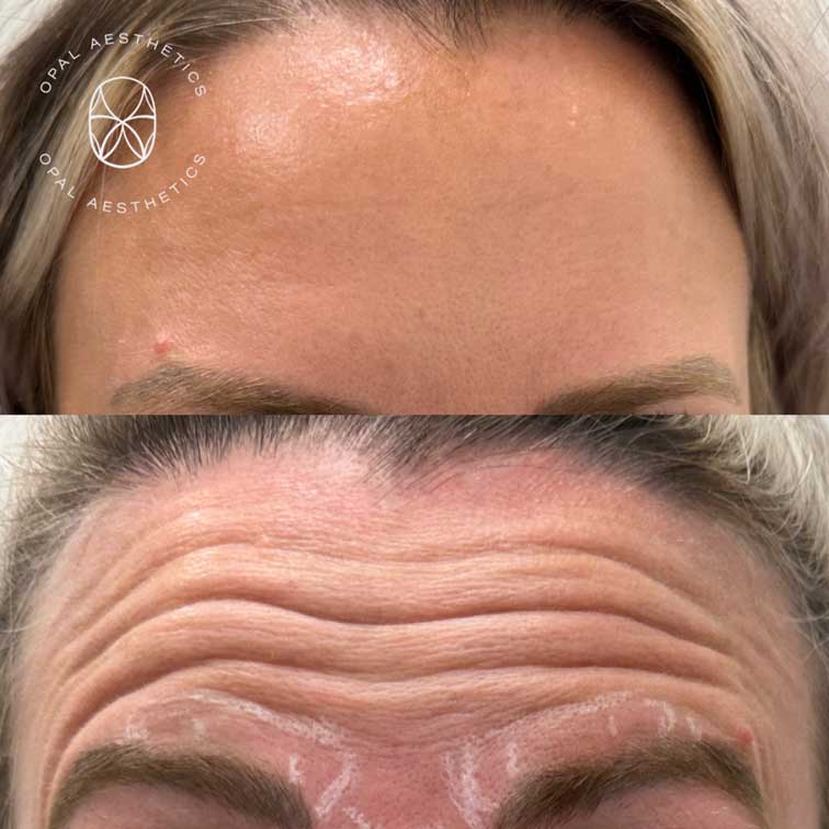 Before and after Botox at Opal Aesthetics Bakersfield