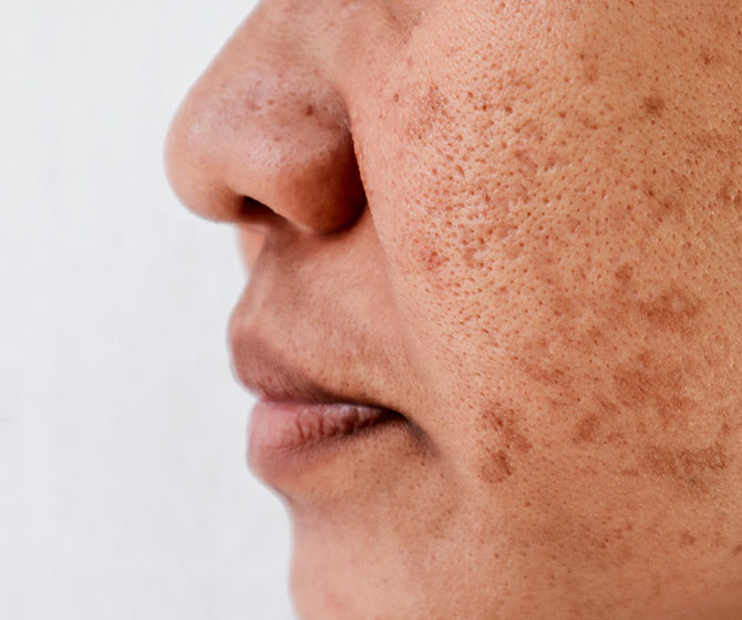 Pigmentation & Melasma treatment in Bakersfield