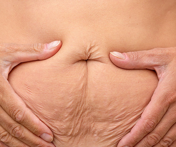 Skin Laxity treatment in Bakersfield