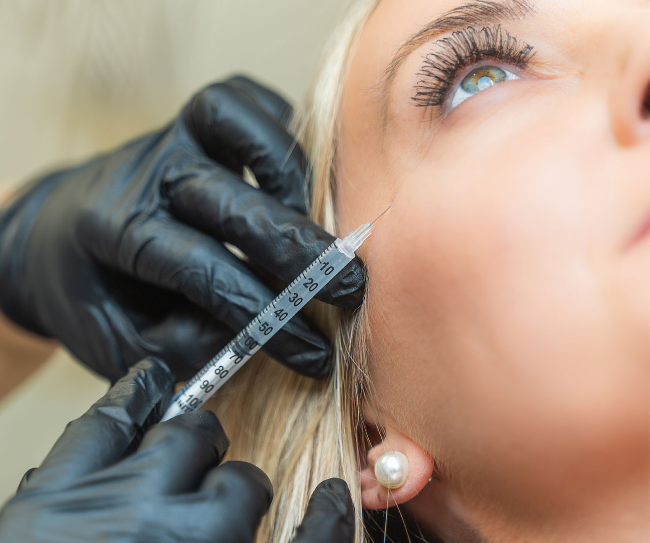 Lip Filler treatment at Opal Aesthetics