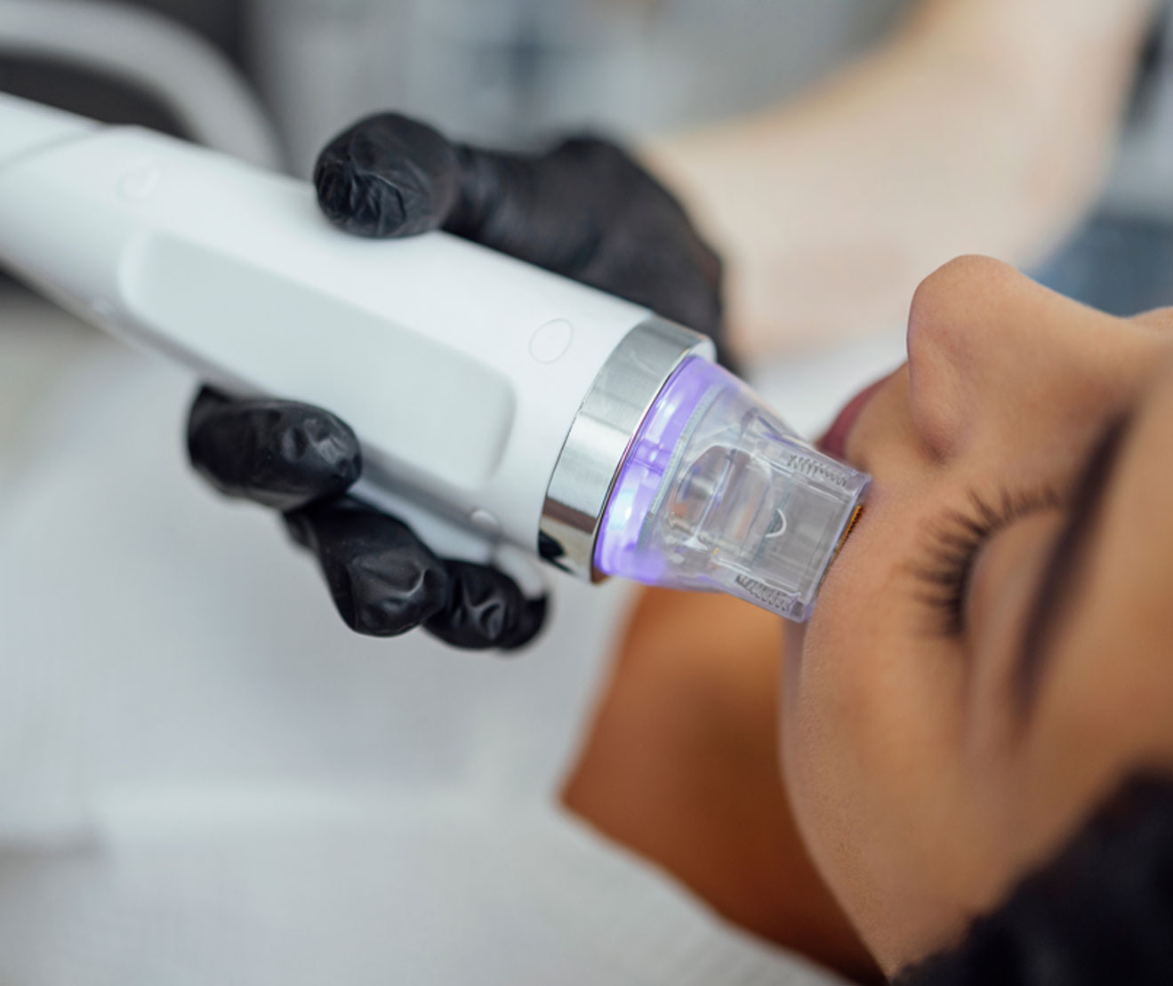 Radiofrequency Microneedling in Bakersfield at Opal Aesthetics