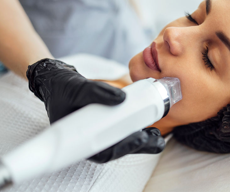 Radiofrequency Microneedling treatment at Opal Aesthetics